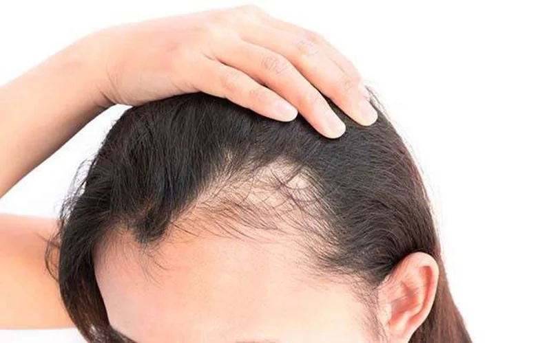 ۵ روش طبیعی برای رشد مجدد موهای ریخته