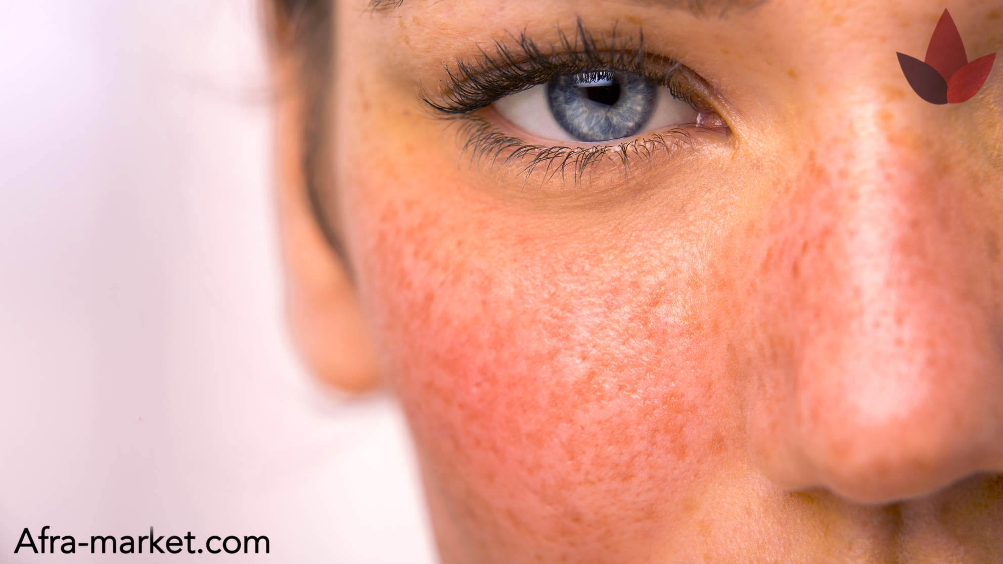 html <img src="your-image-source.jpg" alt="مرطوبکننده بعد از لیزر، حاوی ترکیبات تسکیندهنده و ترمیمکننده پوست">