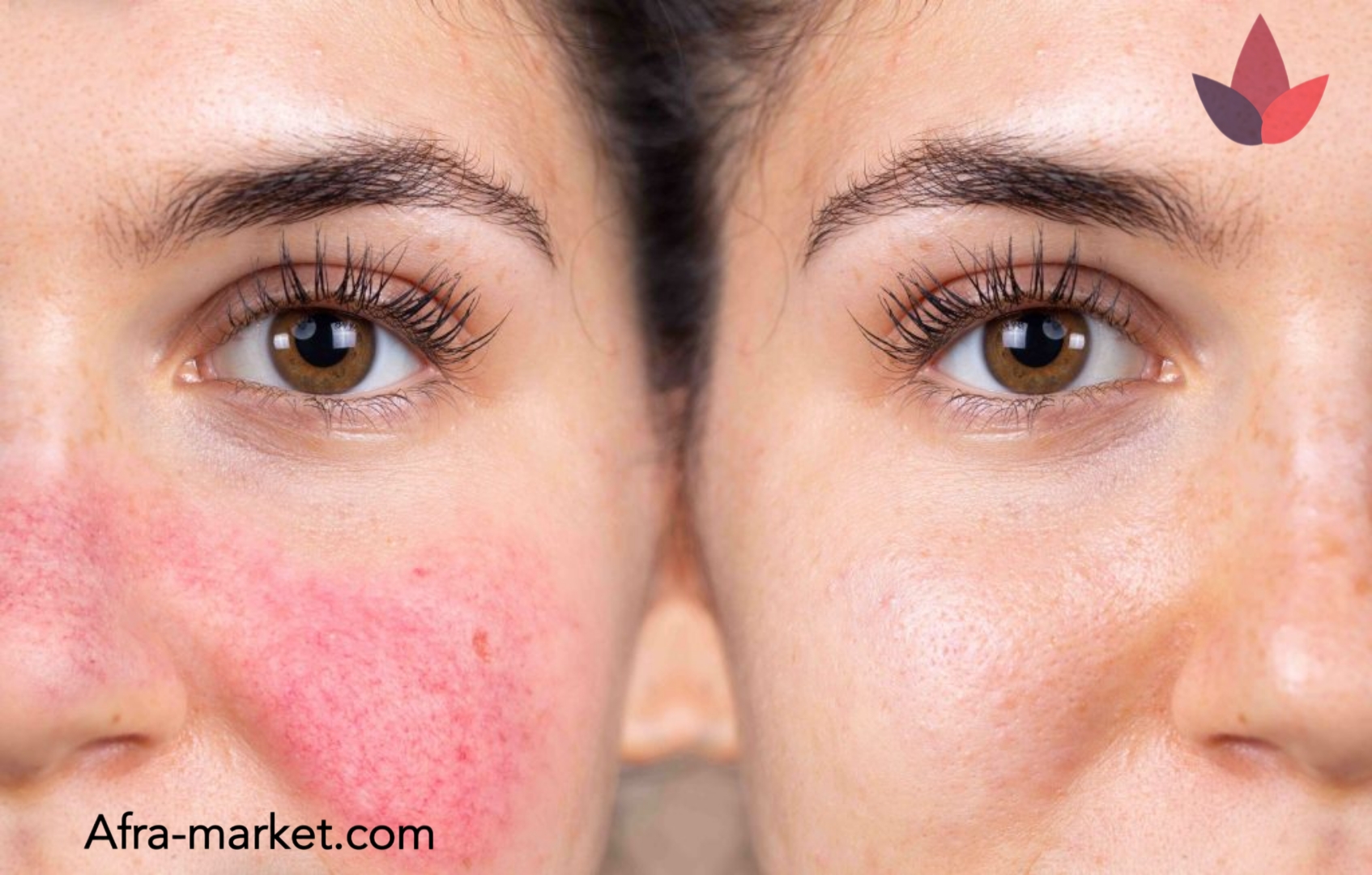 html <img src="your-image-source.jpg" alt="مرطوبکننده حاوی عصارههای طبیعی برای تسکین پوست بعد از لیزر">