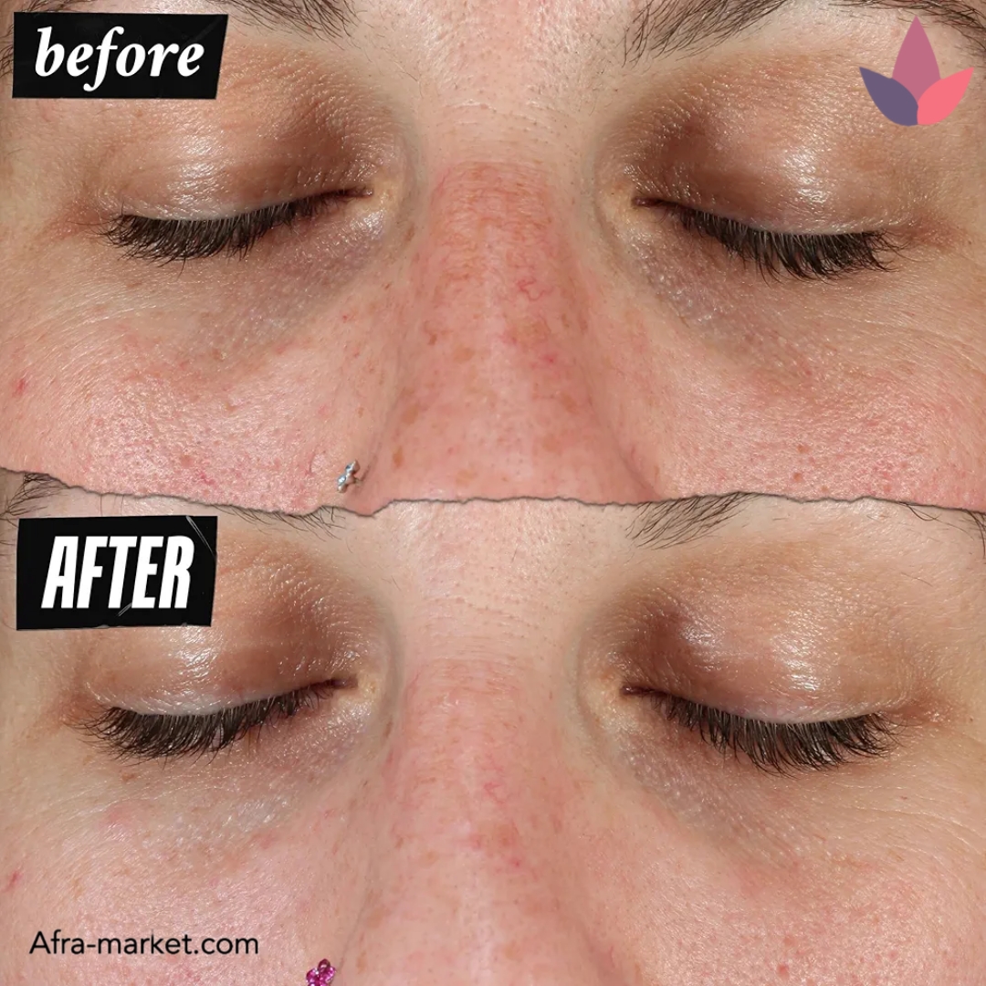 <img src="https://afra-market.com/kiehls-dark-spot-corrector-serum" alt="سرم ضد لک و روشن‌کننده کیلز، دارای ویتامین C، سالیسیلیک اسید و عصاره‌های گیاهی، کمک به افزایش شفافیت و کاهش لک‌های پوستی">