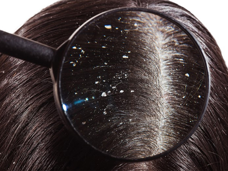 همه چیز در مورد شوره سر ، راه های درمان و کنترل ، بررسی شامپوهای ضد شوره