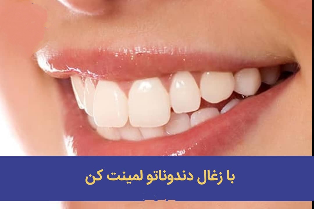 با زغال دندوناتو لمینت کن🦷