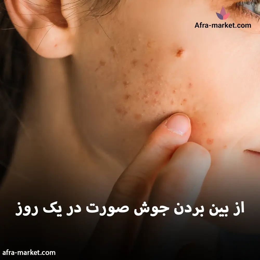 از بین بردن جوش صورت در یک روز